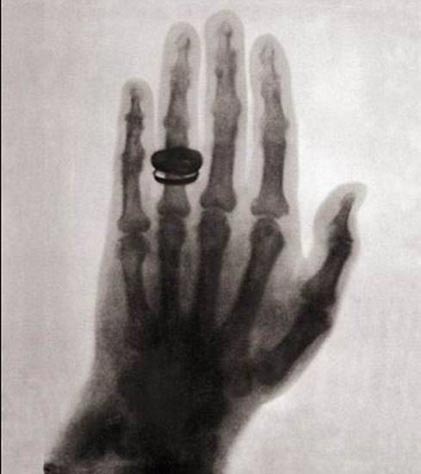 نخستین عکس اشعه ایکس